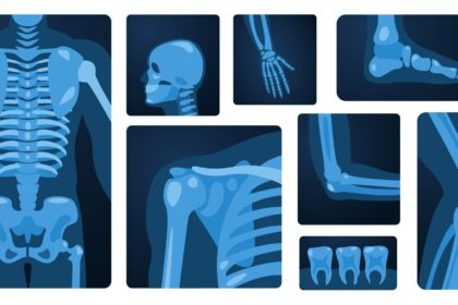 Bone Health and Diabetes: What You Need To Know